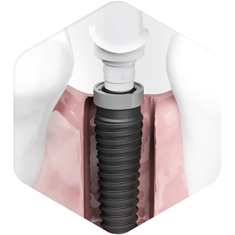 3D illustration of a dental implant.